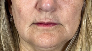 Moxi-BBL HERO and Morpheus8 • Elinea